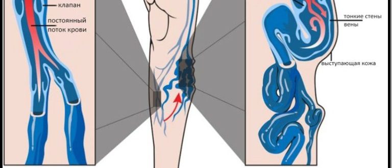 Варикозные Вены Притоки