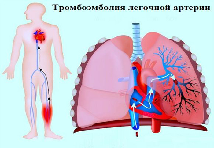 Тромбоз тэла. Тромбоэмболия легочной артерии неотложка. Исходы тромбоэмболии легочной артерии. Эмболия легочной артерии на ЭКГ.