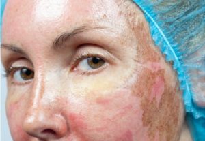 Очищение кожи лица при куперозе thumbnail